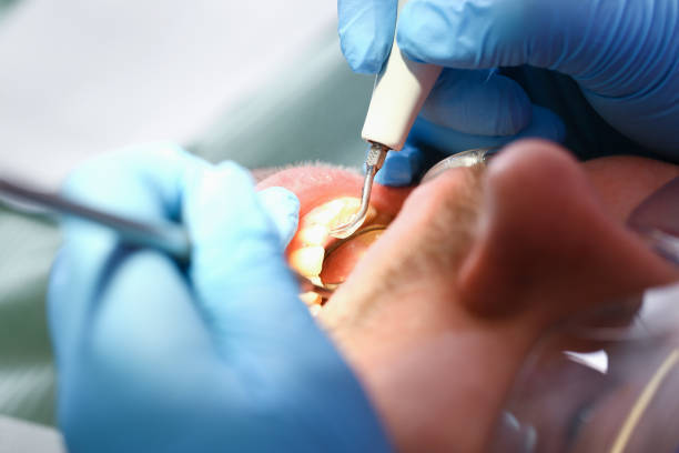 Best Emergency Wisdom Teeth Removal in Schler Park, IL